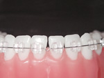 歯の表側矯正